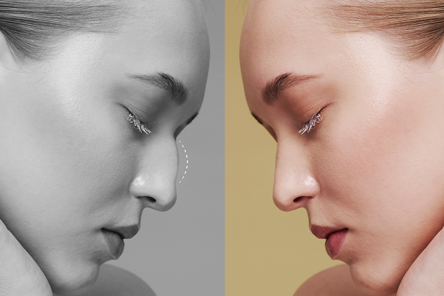 Estetik ve Fonksiyonel Burun Cerrahisi (Rinoplasti)