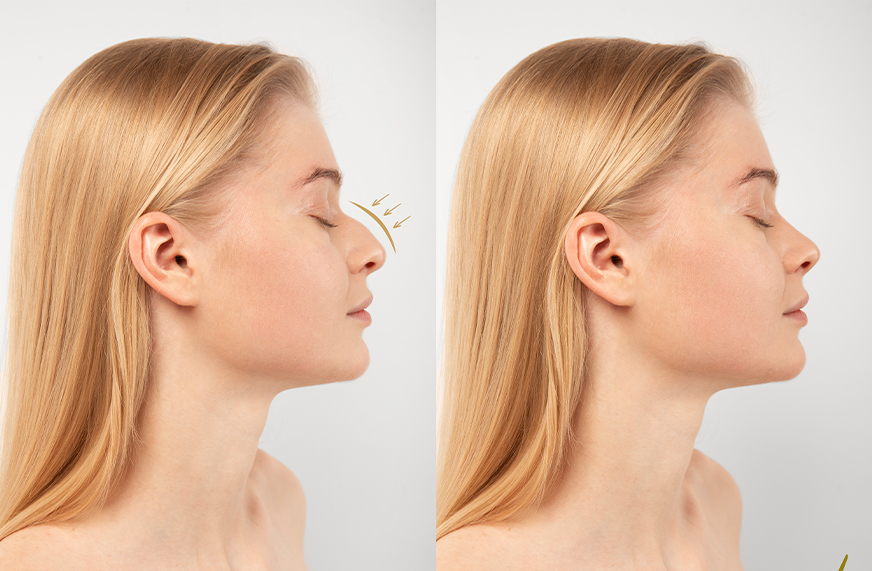 Rinoplasti (Estetik Burun Cerrahisi) Sonrası Dikkat Edilecek Hususlar Nelerdir?