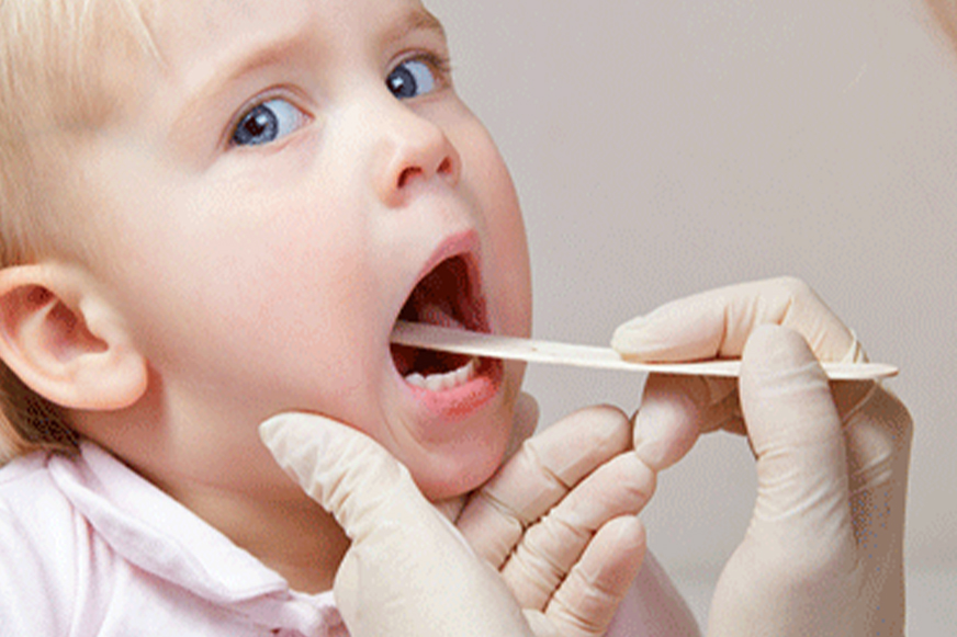 Bademcik İltihabı (Tonsilit)