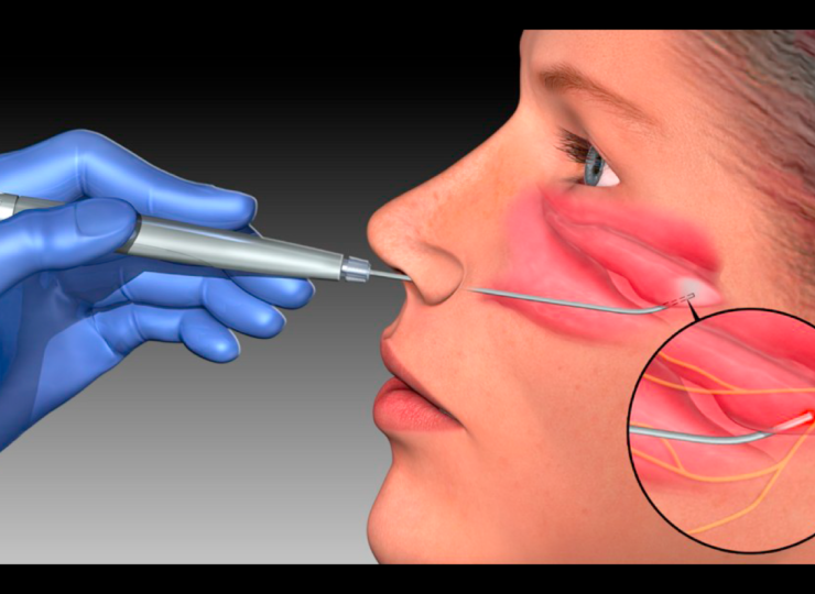 Alerjik Rinit (Bahar Alerjisi) Nedir? Belirtileri ve Tedavi Yöntemleri